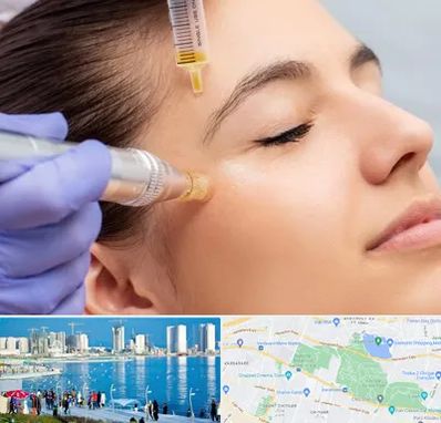 میکرونیدلینگ در چیتگر