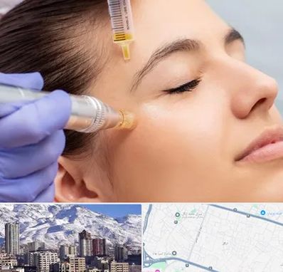 میکرونیدلینگ در ازگل