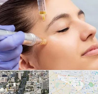 میکرونیدلینگ در منطقه 18 تهران