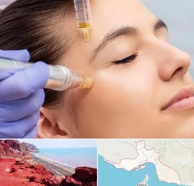 میکرونیدلینگ در هرمزگان