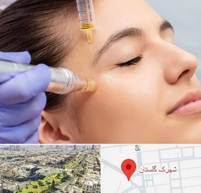 میکرونیدلینگ در شهرک گلستان