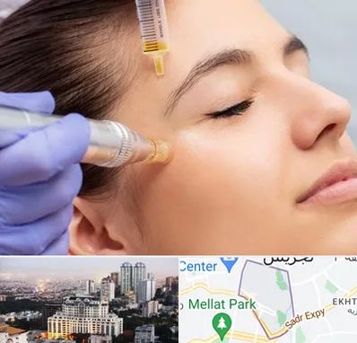 میکرونیدلینگ در الهیه