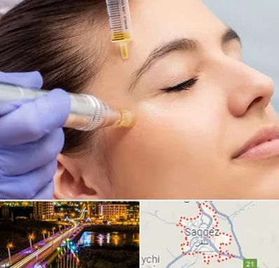 میکرونیدلینگ در سقز