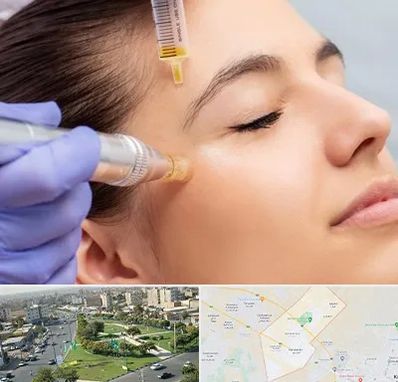 میکرونیدلینگ در کمال شهر کرج