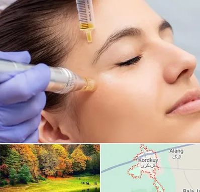 میکرونیدلینگ در کردکوی
