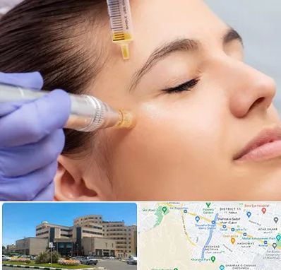 میکرونیدلینگ در صیاد شیرازی مشهد