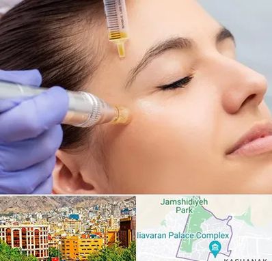 میکرونیدلینگ در نیاوران