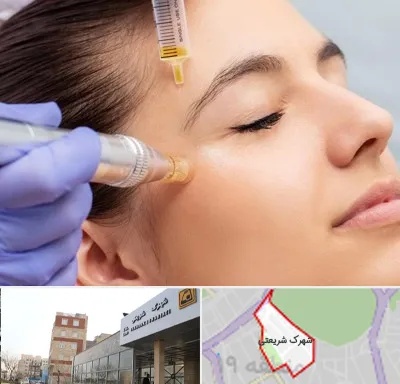 میکرونیدلینگ در شهرک شریعتی