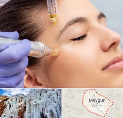 میکرونیدلینگ در میگون