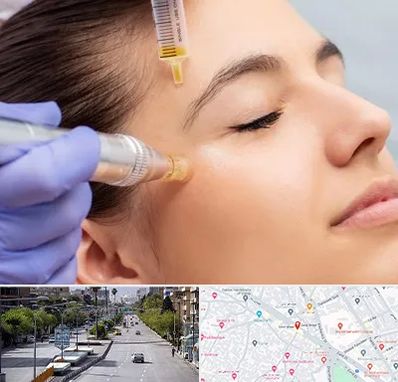 میکرونیدلینگ در خیابان زند شیراز