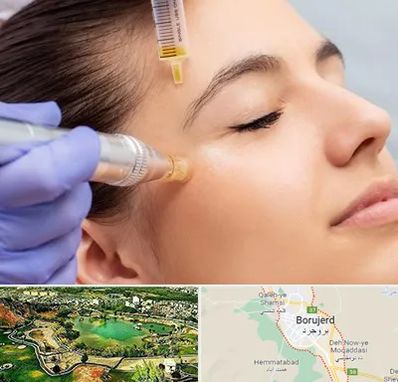 میکرونیدلینگ در بروجرد