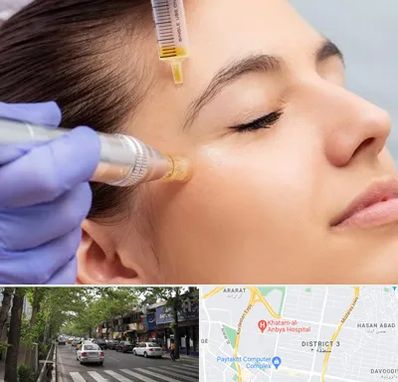 میکرونیدلینگ در ظفر 