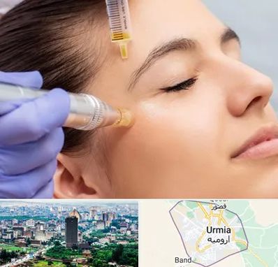 میکرونیدلینگ در ارومیه