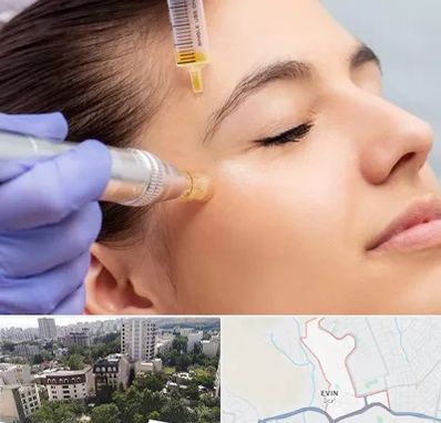 میکرونیدلینگ در اوین