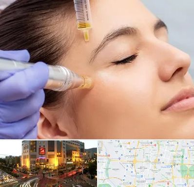 میکرونیدلینگ در جنت آباد تهران