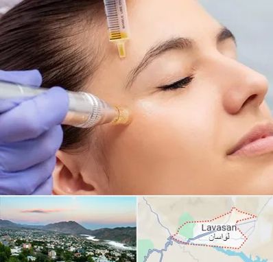 میکرونیدلینگ در لواسان