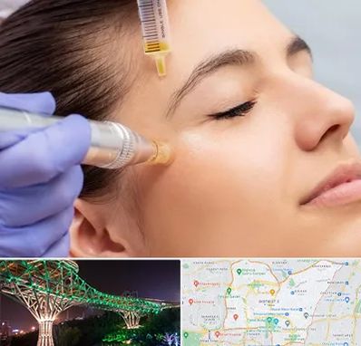 میکرونیدلینگ در منطقه 3 تهران