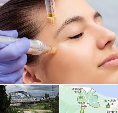 میکرونیدلینگ در چالوس