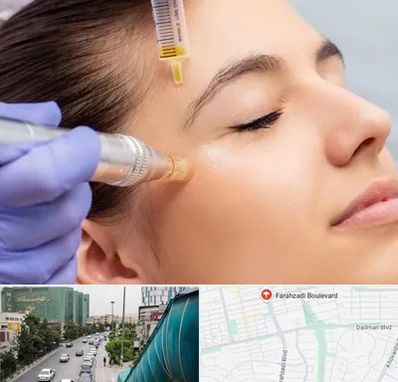 میکرونیدلینگ در بلوار فرحزادی