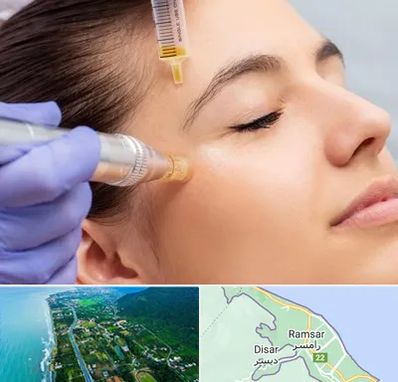 میکرونیدلینگ در رامسر