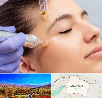 میکرونیدلینگ در خراسان شمالی