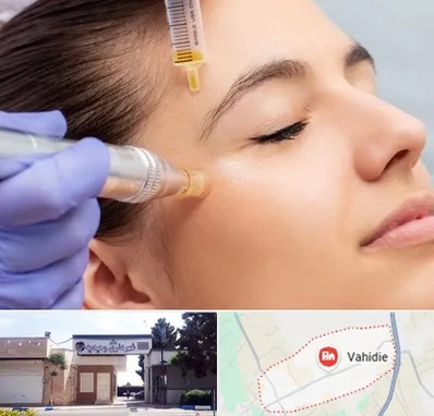 میکرونیدلینگ در وحیدیه شهریار