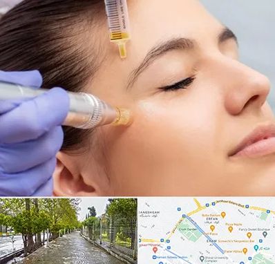 میکرونیدلینگ در خیابان ارم شیراز