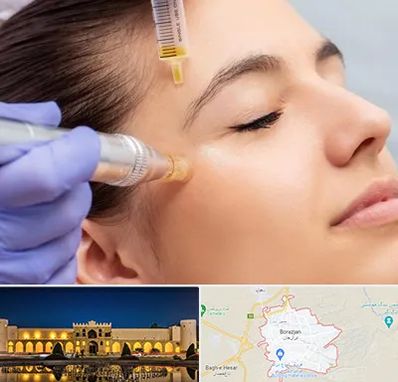 میکرونیدلینگ در برازجان