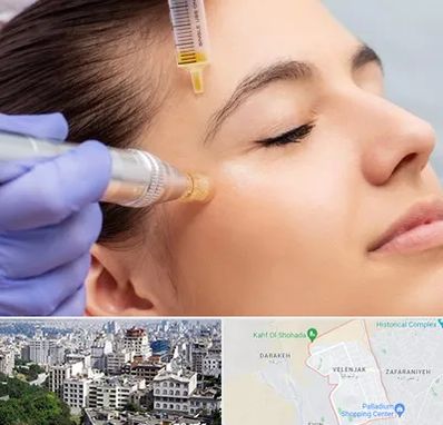 میکرونیدلینگ در ولنجک