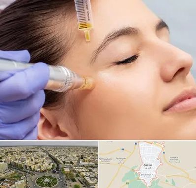 میکرونیدلینگ در قزوین