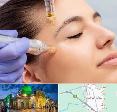 میکرونیدلینگ در آستانه اشرفیه