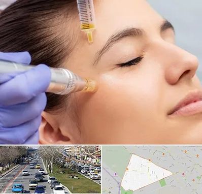 میکرونیدلینگ در احمدآباد مشهد