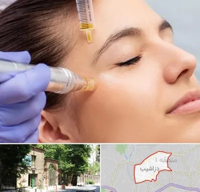 میکرونیدلینگ در دزاشیب