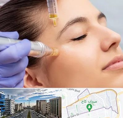 میکرونیدلینگ در سعادت آباد تهران