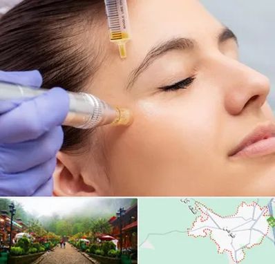 میکرونیدلینگ در فومن