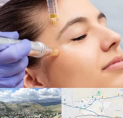 میکرونیدلینگ در رودهن