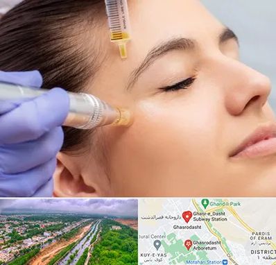 میکرونیدلینگ در قصرالدشت شیراز