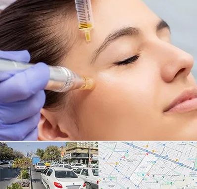 میکرونیدلینگ در مفتح مشهد