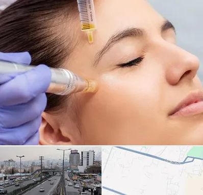 میکرونیدلینگ در بلوار ارتش
