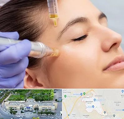 میکرونیدلینگ در نسیم شهر