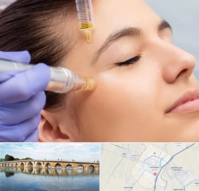 میکرونیدلینگ در فلاورجان