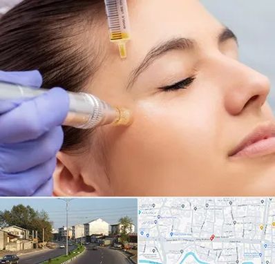 میکرونیدلینگ در ضیابری رشت