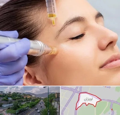 میکرونیدلینگ در لویزان