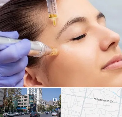 میکرونیدلینگ در کامرانیه