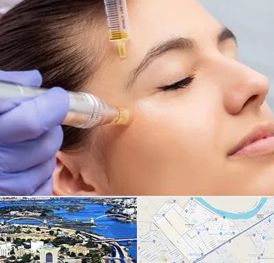 میکرونیدلینگ در کوروش اهواز