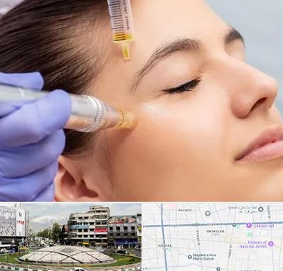 میکرونیدلینگ در مرکز تهران