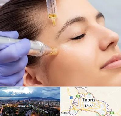 میکرونیدلینگ در تبریز