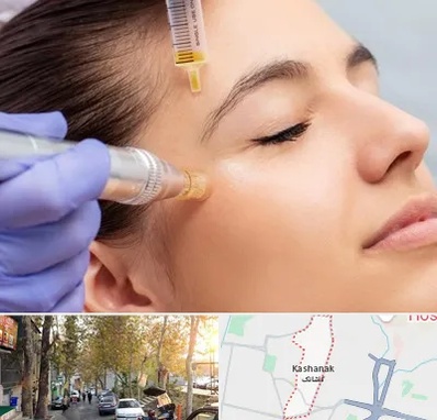 میکرونیدلینگ در کاشانک