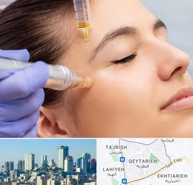 میکرونیدلینگ در قیطریه