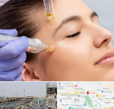 میکرونیدلینگ در بلوار توس مشهد